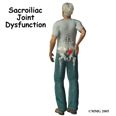 Sacroiliac Joint Dysfunction Patient Guide
