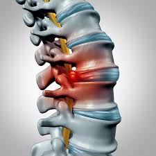 I HAVE DEGENERATIVE DISC DISEASE.  WHAT DOES THAT MEAN?